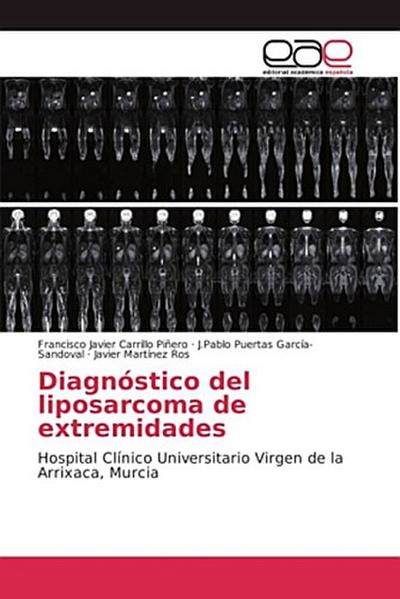 Diagnóstico del liposarcoma de extremidades