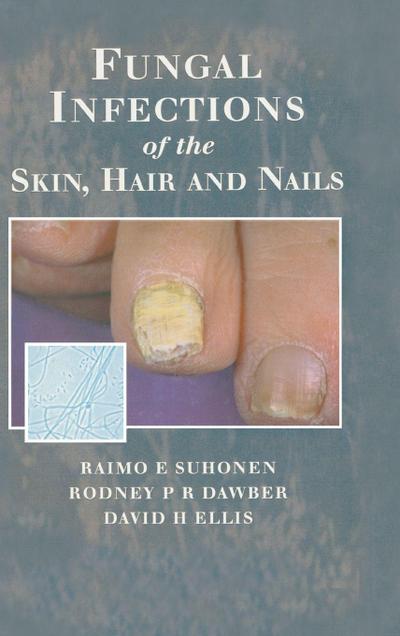 Fungal Infections of the Skin and Nails