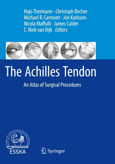 The Achilles Tendon