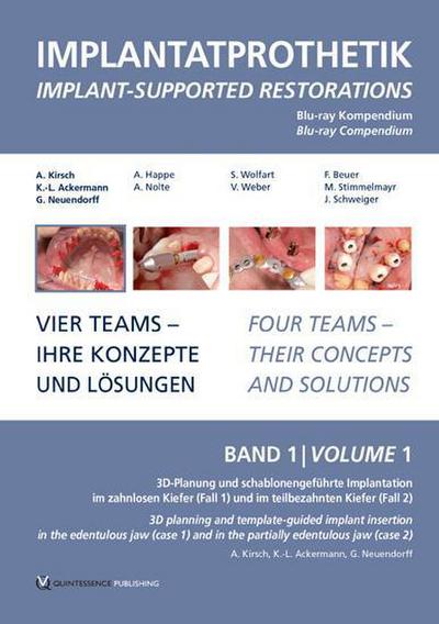 Implantatprothetik. Blu-Ray, Band 1