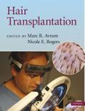 Hair Transplantation