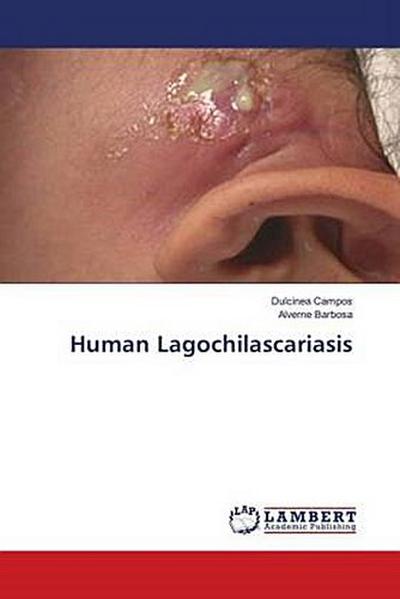 Human Lagochilascariasis