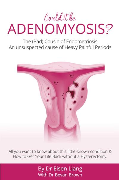 Adenomyosis -The Bad Cousin of Endometriosis