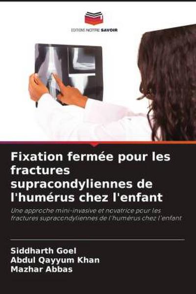 Fixation fermée pour les fractures supracondyliennes de l’humérus chez l’enfant