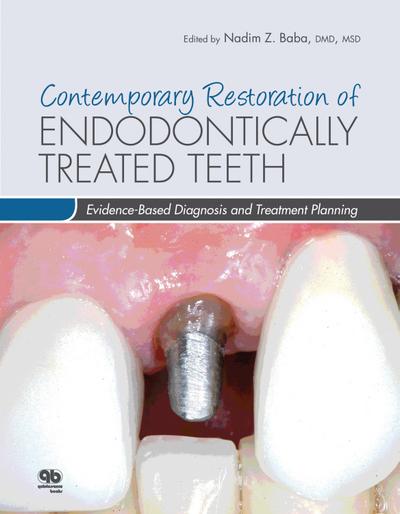 Contemporary Restoration of Endodontically Treated Teeth