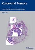 Colorectal Tumors