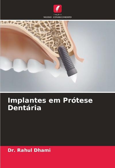 Implantes em Prótese Dentária