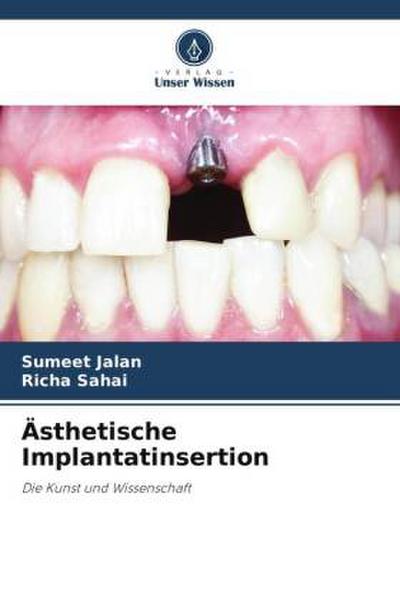 Ästhetische Implantatinsertion