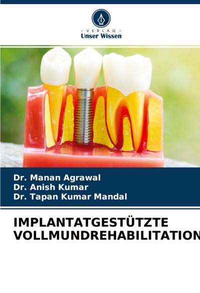 IMPLANTATGESTÜTZTE VOLLMUNDREHABILITATION