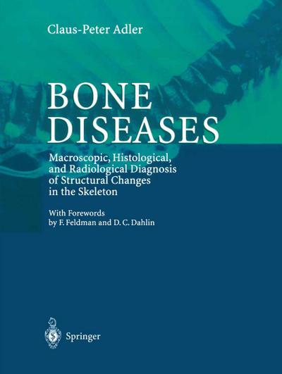 Bone Diseases