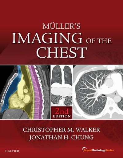 Muller’s Imaging of the Chest E-Book