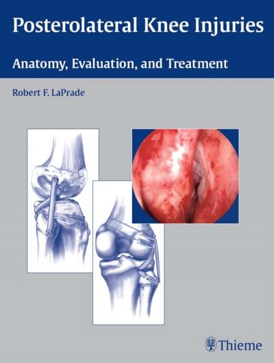 Posterolateral Knee Injuries