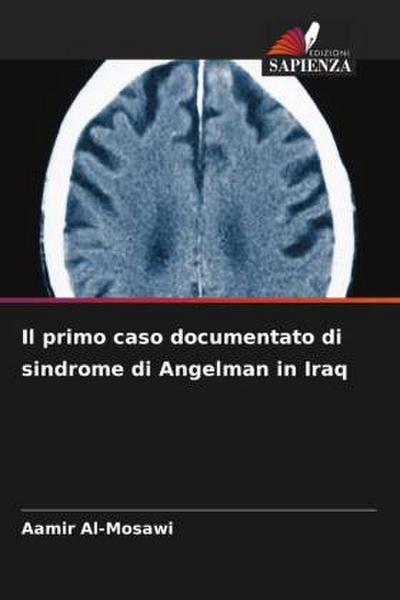 Il primo caso documentato di sindrome di Angelman in Iraq