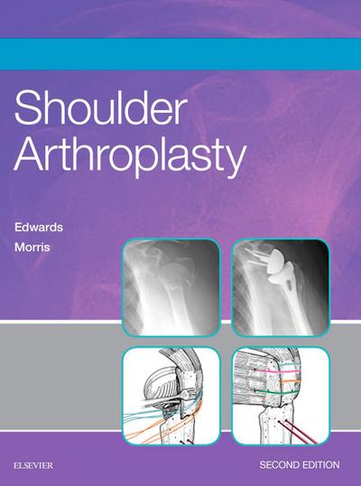 Shoulder Arthroplasty E-Book