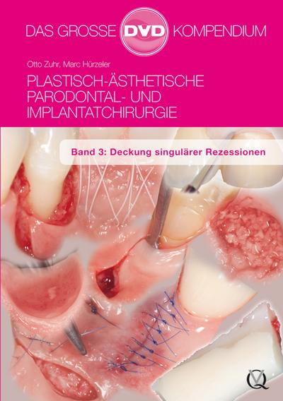 Plastisch-Ästhetische Parodontal- und Implantatchirurgie / Plastisch-Ästhetische Parodontal- und Implantatchirurgie