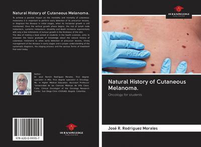 Natural History of Cutaneous Melanoma.
