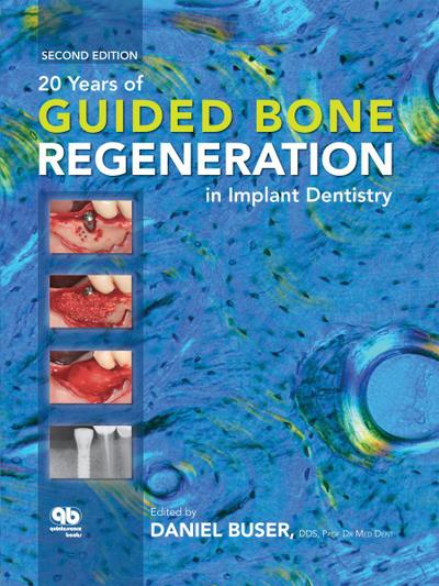 20 Years of Guided Bone Regeneration in Implant Dentistry (eBook, EPUB) - Daniel Buser