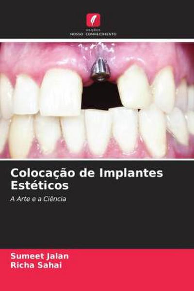 Colocação de Implantes Estéticos