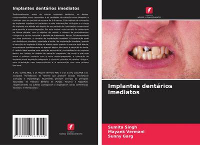 Implantes dentários imediatos
