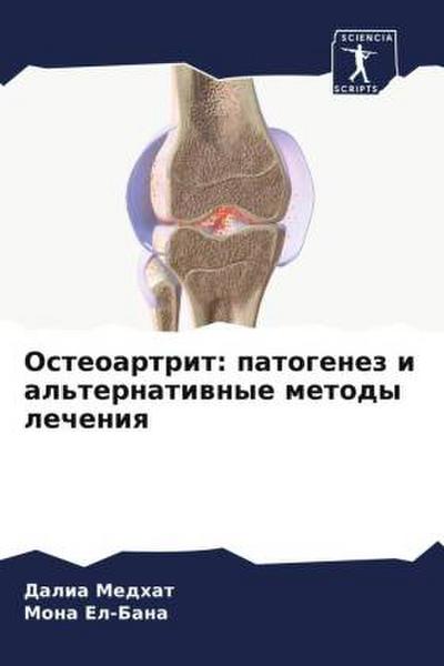 Osteoartrit: patogenez i al’ternatiwnye metody lecheniq