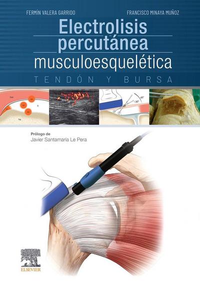 Electrolisis percutánea musculoesquelética : tendón y bursa