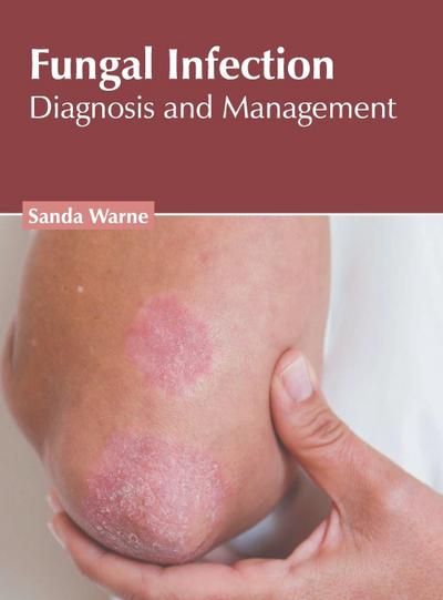 Fungal Infection: Diagnosis and Management