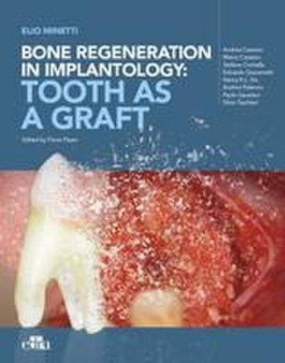 Bone Regeneration in Implantology: Tooth as a Graft