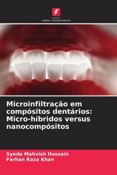 Microinfiltração em compósitos dentários: Micro-híbridos versus nanocompósitos