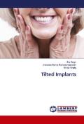 Tilted Implants