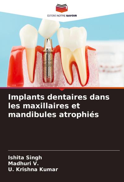 Implants dentaires dans les maxillaires et mandibules atrophiés