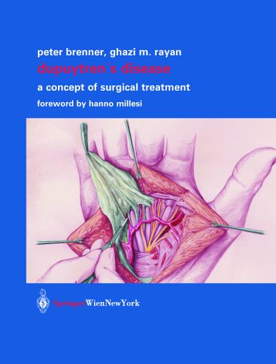 Dupuytren’s Disease