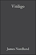 Vitiligo