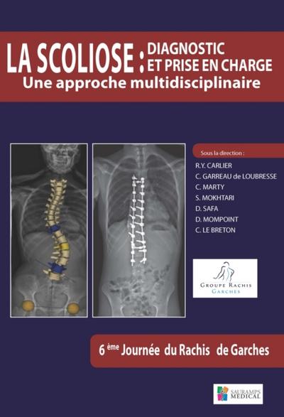 La scoliose : diagnostic et prise en charge
