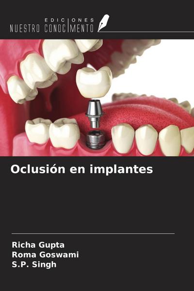 Oclusión en implantes