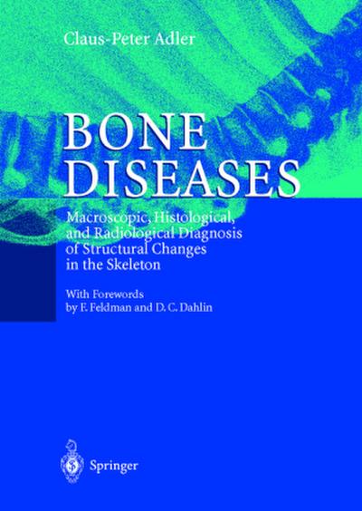 Bone Diseases
