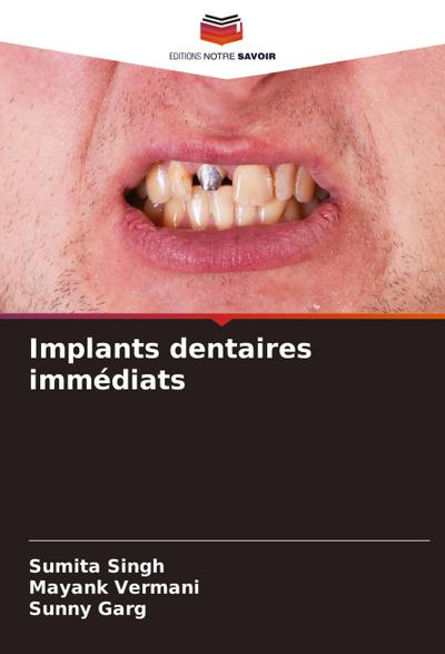 Implants dentaires immédiats