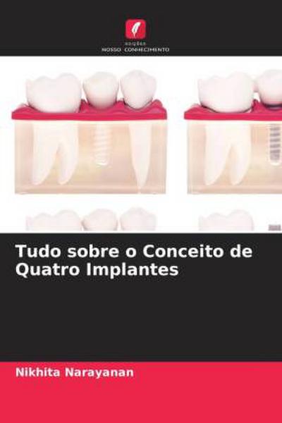 Tudo sobre o Conceito de Quatro Implantes