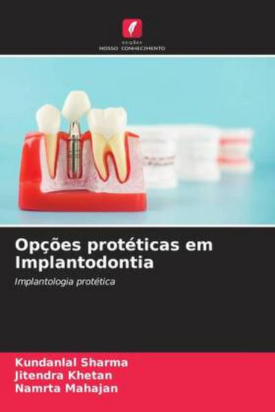 Opções protéticas em Implantodontia