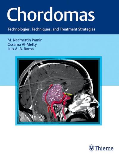 Chordomas