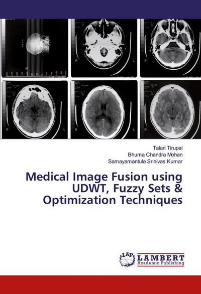 Medical Image Fusion using UDWT, Fuzzy Sets & Optimization Techniques