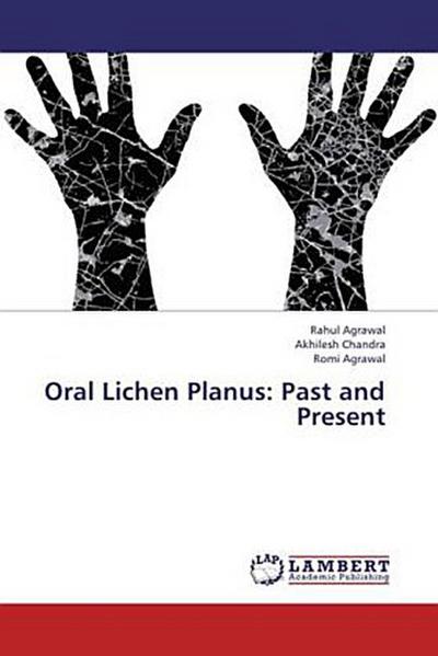 Oral Lichen Planus: Past and Present