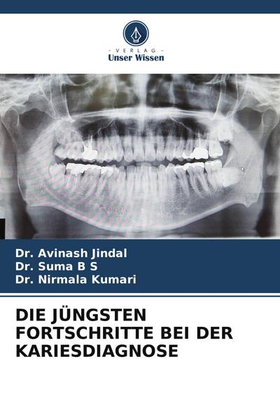 DIE JÜNGSTEN FORTSCHRITTE BEI DER KARIESDIAGNOSE