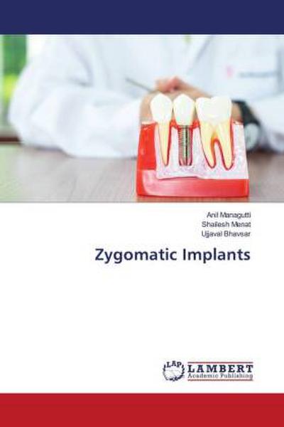 Zygomatic Implants