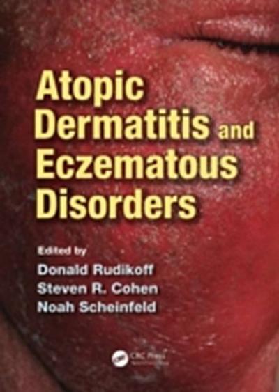 Atopic Dermatitis and Eczematous Disorders