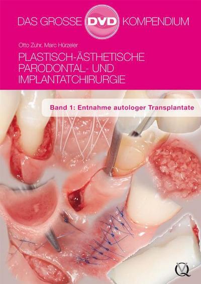 Plastisch-Ästhetische Parodontal- und Implantatchirurgie
