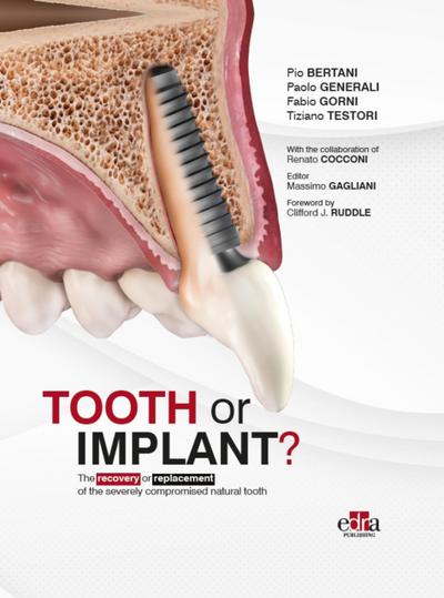 Tooth or Implant?