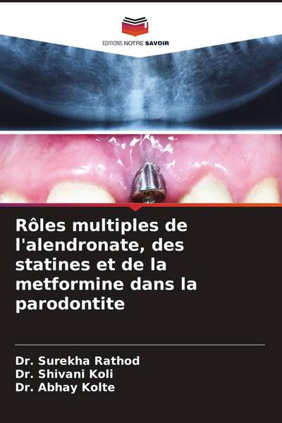 Rôles multiples de l’alendronate, des statines et de la metformine dans la parodontite