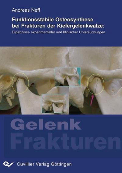 Funktionsstabile Osteosynthese bei Frakturen der Kiefergelenkwalze - Andreas Neff