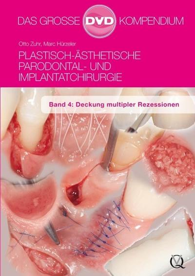 Plastisch-Ästhetische Parodontal- und Implantatchirurgie