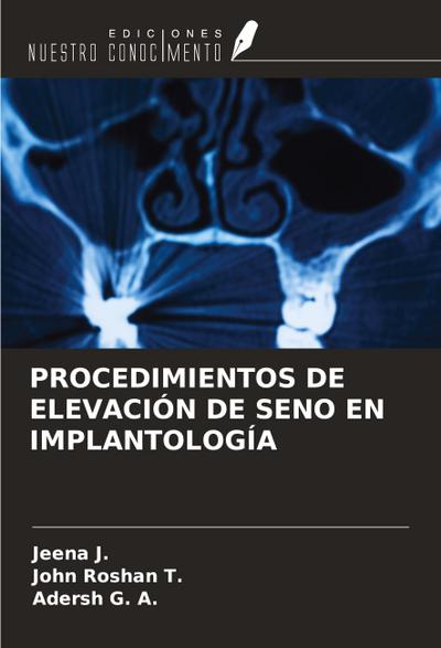 PROCEDIMIENTOS DE ELEVACIÓN DE SENO EN IMPLANTOLOGÍA